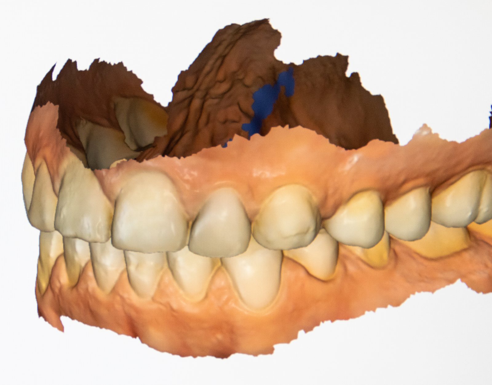 Dreidimensionaler Kieferscan aus dem Intraoralscanner